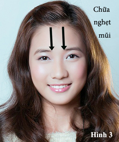 Chữa nghẹt mũi