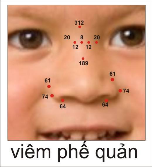 Viêm phế quản