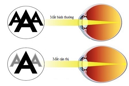 cận thị là gì, hiểu biết cơ bản về bệnh cận thị